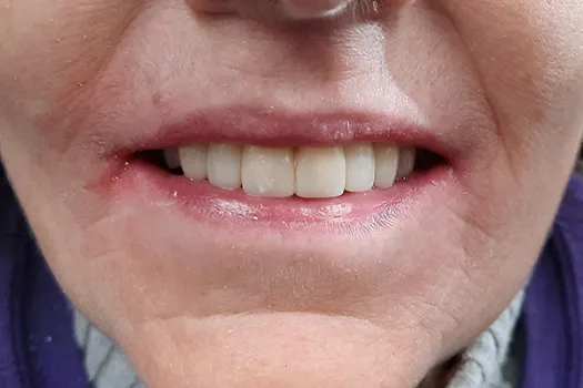 Crowns After Photo 2