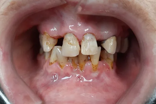 Crowns Before Photo 1