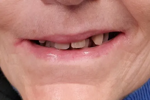 Crowns Before Photo 2