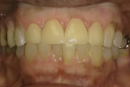 Front Crowns After Photo 1