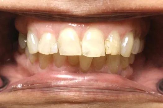 Front Crowns Before Photo 1