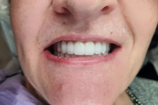 Teeth In A Day After Photo 1