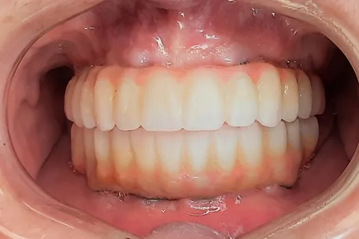 Teeth In A Day After Photo 2