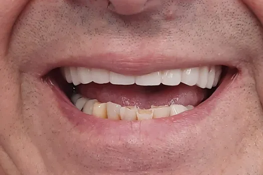 Teeth In A Day After Photo 3