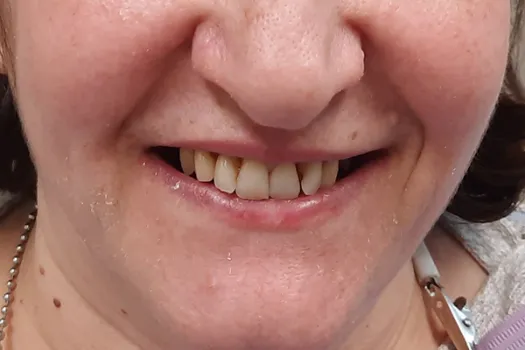 Teeth In A Day Before Photo 1