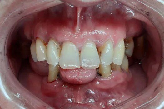 Teeth In A Day Before Photo 2