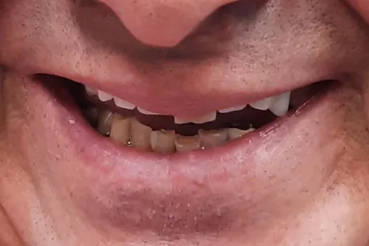 Teeth In A Day Before Photo 3