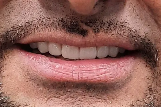 Veneers After Photo 1