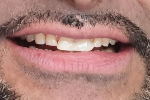 Veneers Before Photo 1